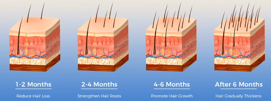 Laser in Hair Growth Devices Laser in Hair Growth Devices